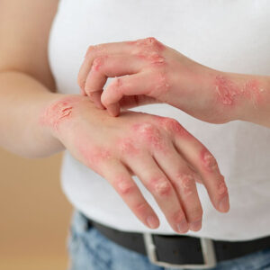 تاثیر عسل بر اگزما